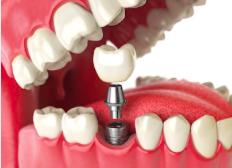 Курс з імплантації